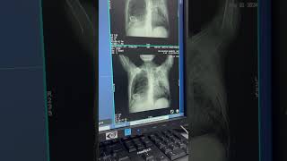 HRCT LUNGS SCANNING 🫁 [upl. by Bart]