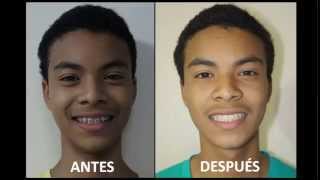 ORTODONCIA ANTES Y DESPUÉSPACIENTE CON DIASTEMA By DR JAVIER TOMALÁ ROSALES [upl. by Benoite21]