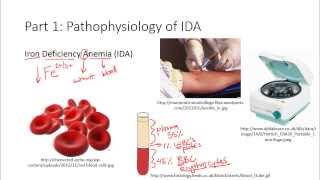 iron deficiency anemia  iron deficiency anemia pathophysiology  iron deficiency anemia b pharmacy [upl. by Leipzig962]