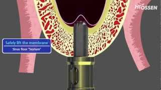 OSSTEM  HIOSSEN CASKit Crestal Approach Sinus Kit [upl. by Mirna]