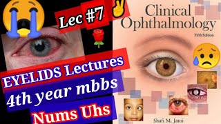 🔴Clinical Ophthalmology Lecture 7 Eyelids topic Blepharitis inflammation of Eyelids [upl. by Ecenahs]