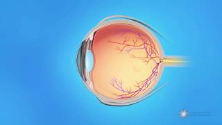 What is central retinal vein occlusion CRVO [upl. by Sternberg]