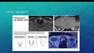 Demyelination beyond multiple sclerosis [upl. by Nobell]