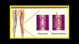 Symptome von Thrombose [upl. by Retluoc732]