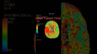 Stroke amp CT Perfusion [upl. by Abagail]