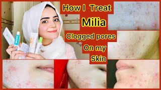 How To Treat Milia Clogged Pores Permanently At Home  Self Experienced  Dietitian Aqsa [upl. by Hsirk]