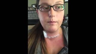 Thyroidectomy Surgery Recovery [upl. by Aiekram]