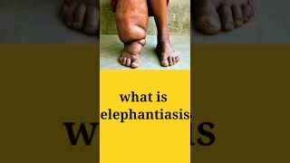 what is elephantiasis peir hathi jeshaà honaa peir mai shujaan elephantiasis disease [upl. by Eilhsa95]