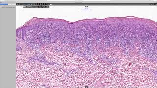 Lichenoid keratosis Phillip H McKee Antonina Kalmykova amp CSD Health Care [upl. by Imoyn]