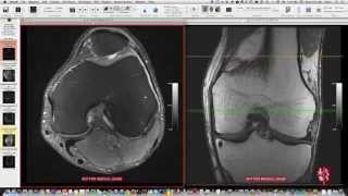 Systematic Interpretation of Knee MRI How I do it [upl. by Yhtomit222]