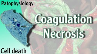 Pathophysiology  Coagulation Necrosis Hani Laith شرح [upl. by Orat485]