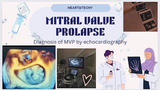 MITRAL VALVE PROLAPSE [upl. by Accever405]