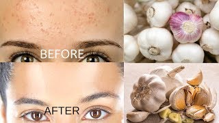 Remove Forehead Pimples Overnight  Acne Treatment with Garlic [upl. by Pond]