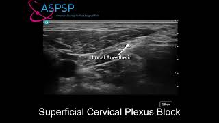 Ultrasound Guided Superficial Cervical Plexus Block [upl. by Eiser]