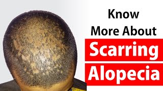 Cicatricial Alopecia Or Scarring Alopecia Natural Treatment At Dr Rohits Alopecia Treatment Center [upl. by Nonnaihr]