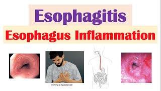 Esophagitis Esophagus Inflammation Causes Risk Factors Signs and Symptoms Diagnosis Treatment [upl. by Pessa900]