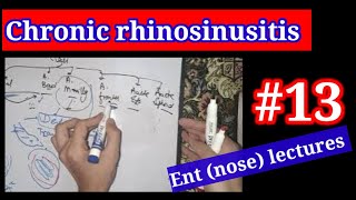 chronic rhinosinusitis 🔴 ENT NOSE LECTURES 13 SINUSES [upl. by Meece362]