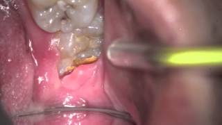 Wisdom Teeth need extraction for various reasons [upl. by Alleram100]