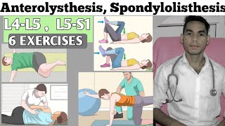 Anterolisthesis spondylolisthesis l4 L5s1 exercise treatment Low back pain exercises Disc bulged [upl. by Annaillil993]