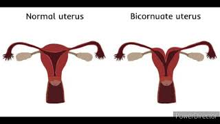 Meaning of Bicornuate uterus [upl. by Dorren]