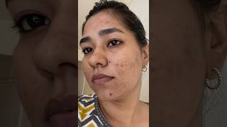 How to CORRECT your SKIN☺️Acne DARK Spots  skin care acneproneskin [upl. by Hajar83]