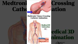 Medtronic Viance Crossing Catheter Cardiovascular Animation medical animation 3d short [upl. by Ylecic]