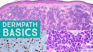 Basic Dermpath Cases  Explained by a Dermatopathologist [upl. by Odyssey]