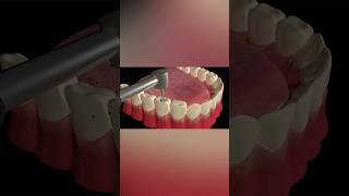 Tooth Cavity Filling Procedure tooth health shorts [upl. by Verdha]