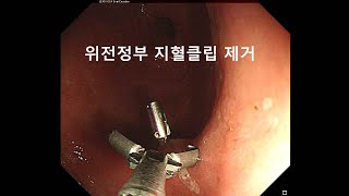 위내시경 위전정부 지혈 클립 제거 The process of removing a hemostatic clip using endoscopy [upl. by Eimma]