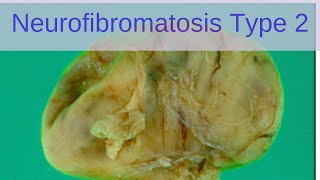 Neurofibromatosis Type 2 NF2  Pathology mini tutorials [upl. by Gautier975]