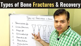 Types of Bone Fractures Open and Closed Fracture Everything you need to know Fracture Healing [upl. by Jaquenetta]