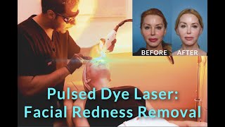 Pulsed Dye Laser Facial Redness Removal  with Dr Sameer Bashey  Over 50 [upl. by Aihseuqal500]