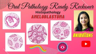 Ameloblastoma Odontogenic TumorsI Follicular PlexiformAcanthomatous Granular [upl. by Nosneh]