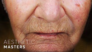 Laser Resurfacing for Deep Wrinkles  CO2 Laser [upl. by Attevad540]