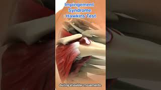 Shoulder Pain Impingement Syndrome And The Hawkins Test [upl. by Submuloc]