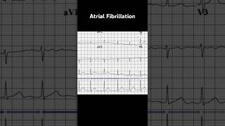 Atrial Fibrillation ECG No p waves [upl. by Tolmach]