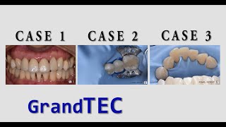 Intra amp Extra Coronal Splinting in Periodontal Treatment❗ Glass Fiber Reinforced Composite GrandTEC [upl. by Nojram77]