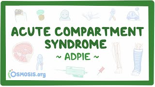 Compartment Syndrome Nursing Process [upl. by Aihsinat48]