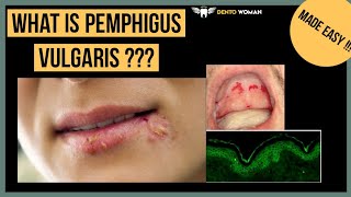 pemphigus vulgaris  made easy [upl. by Akinhoj]