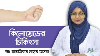 Keloid Scar Treatment Prevention Remedies Symptom  Keloid treatment bangla  ত্বকের সমস্যা [upl. by Abshier]