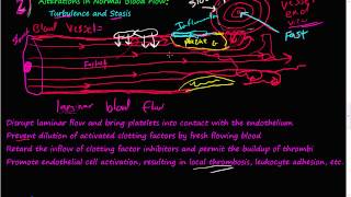 54  Turbulence Stasis Thrombosis Virchows triad Laminar blood flow [upl. by Ilsel]