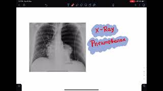 XRay of Pneumothorax xray pneumothorax radiology imaging xraytutorial chestxray [upl. by Aglo495]