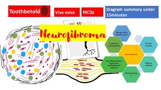 Neurofibromatosis Causes Signs and Symptoms Diagnosis and Treatment [upl. by Aitnecserc971]