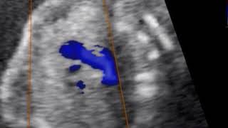 Hipoplasia de ventrículo izquierdo en gestante de 19 semanas con antecedente de TN aumentada [upl. by Hayidah]