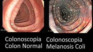 Comparación Colon Normal y Colon con Melanosis Coli [upl. by Persse]