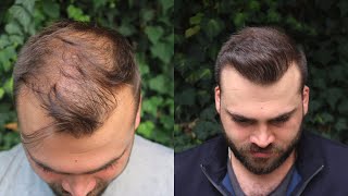 Hair Transplant Result with 3040 Grafts  EXTREME TRANSFORMATION from 0 days to 10 Months [upl. by Ennovad]