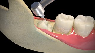 Wisdom Teeth Extraction  Step by step [upl. by Ameehsat]