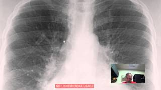 CXR Pulmonary Vascular Congestion Discussed by Radiologistmp4 [upl. by Yllib]