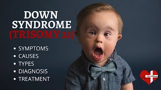 What is Down Syndrome Trisomy 21 Down syndrome Trisomy 21 Made Easy [upl. by Ralf]