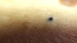 close up blackhead comedone extract 21 [upl. by Llywellyn561]